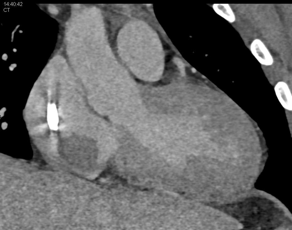 Clot in Right Atrium off the Indwelling Catheter - CTisus CT Scan