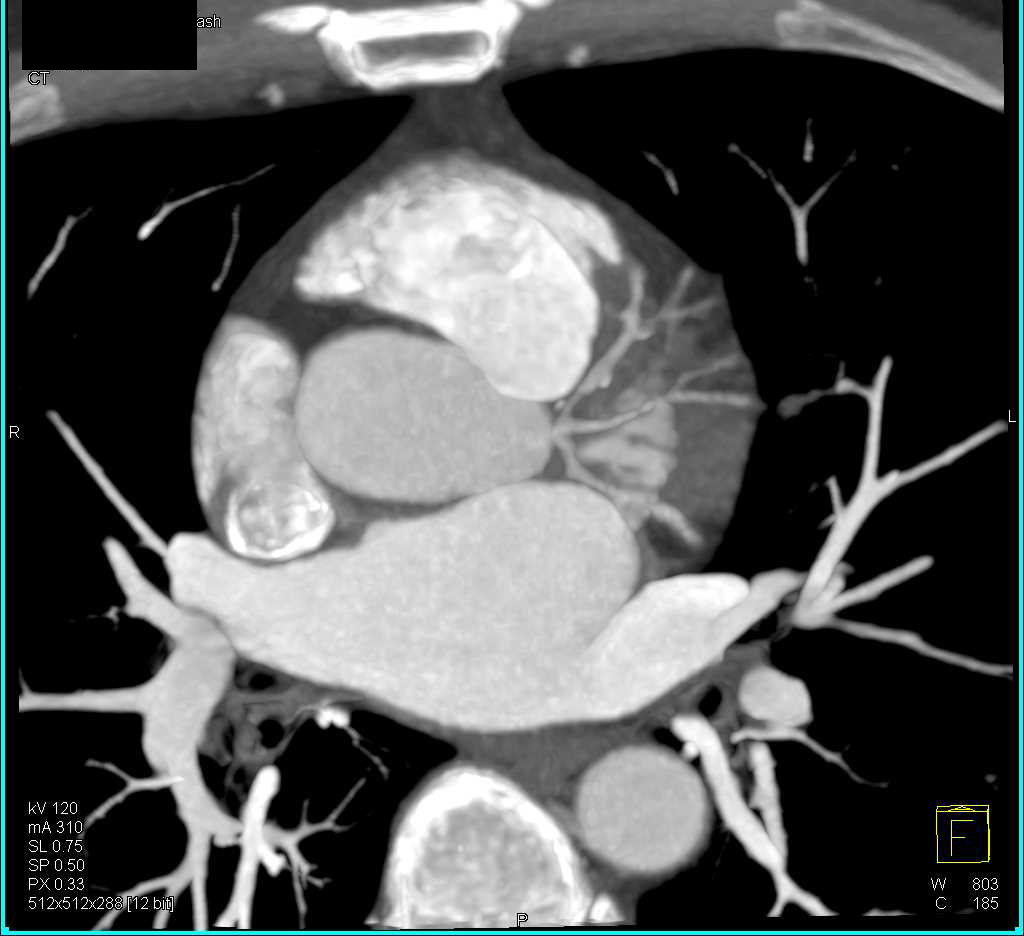 CCTA with High Grade Left Anterior Descending Coronary Artery (LAD) Stenosis - CTisus CT Scan