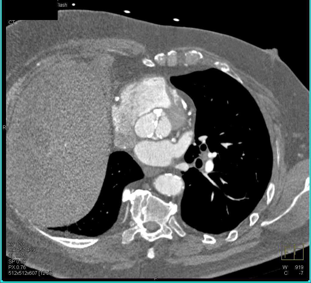 Bicuspid Aortic Valve with Dilated Ascending Aorta - CTisus CT Scan