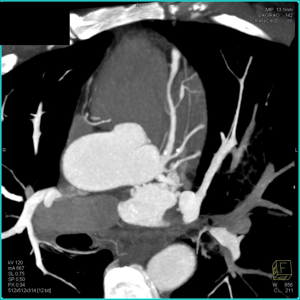 Myocardial Bridging Left Anterior Descending Coronary Artery (LAD) - CTisus CT Scan