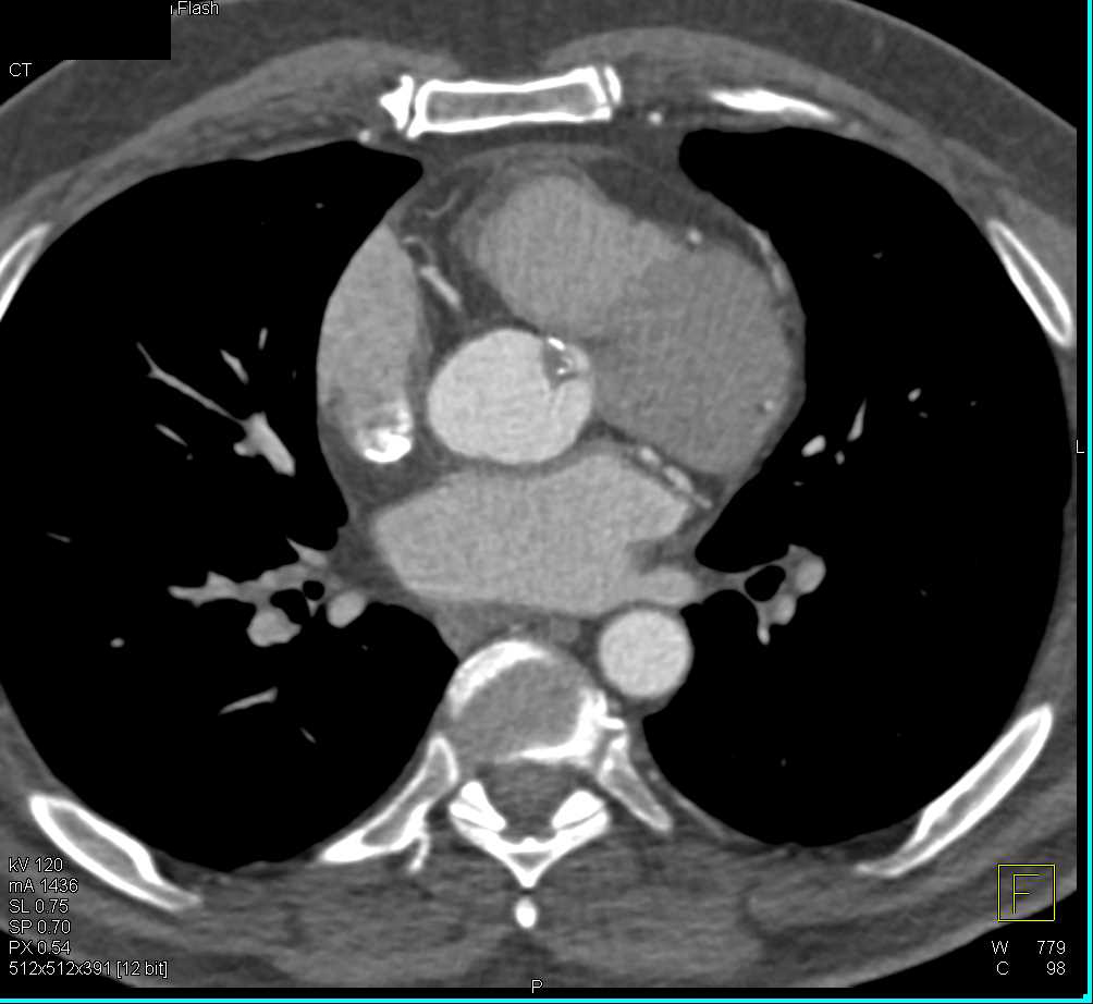 Non Calcified Thrombus on Aortic Valve - CTisus CT Scan
