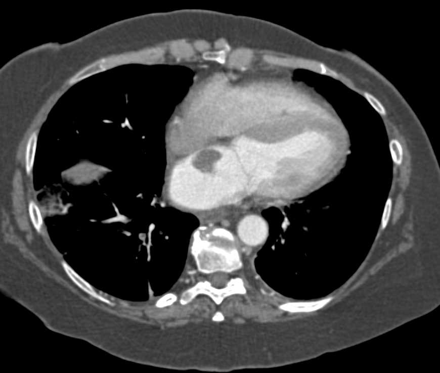 Left Atrial Myxoma and Multiple Pulmonary Emboli (PEs) - CTisus CT Scan