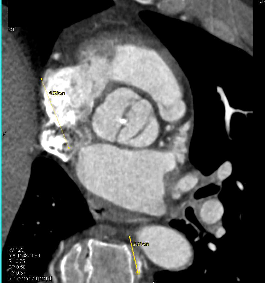 Bicuspid Aortic Valve - CTisus CT Scan