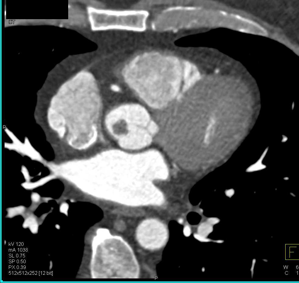 Papillary Fibroelastoma on the Aortic Valve - CTisus CT Scan