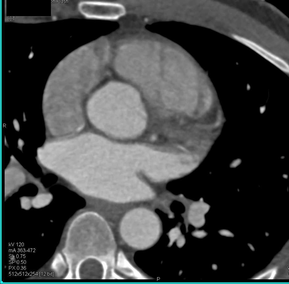 Normal Left Atrial Appendage - CTisus CT Scan
