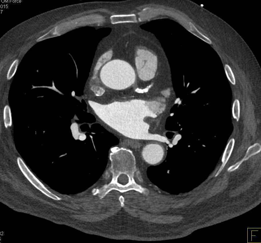 Pseudothrombus in the Left Atrial Appendage - CTisus CT Scan