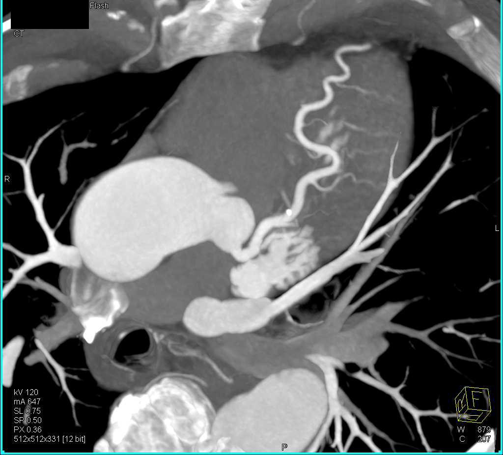 CCTA with Minimal Plaque Left Anterior Descending Coronary Artery (LAD) - CTisus CT Scan