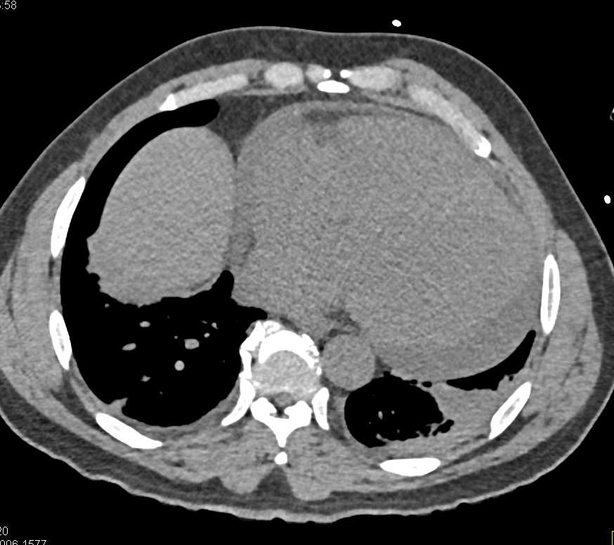 Ulceration Aortic Root and Pericardial Effusion - CTisus CT Scan