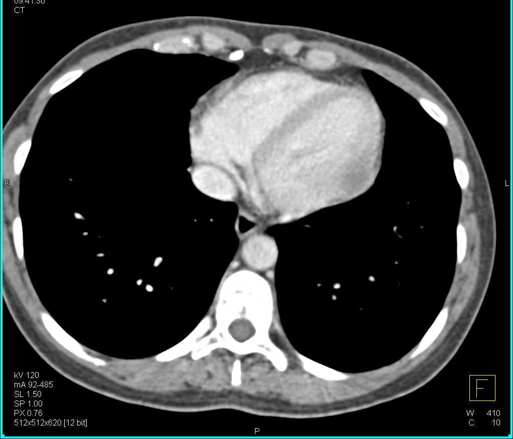 Angiosarcoma Involves the Left Ventricle - CTisus CT Scan