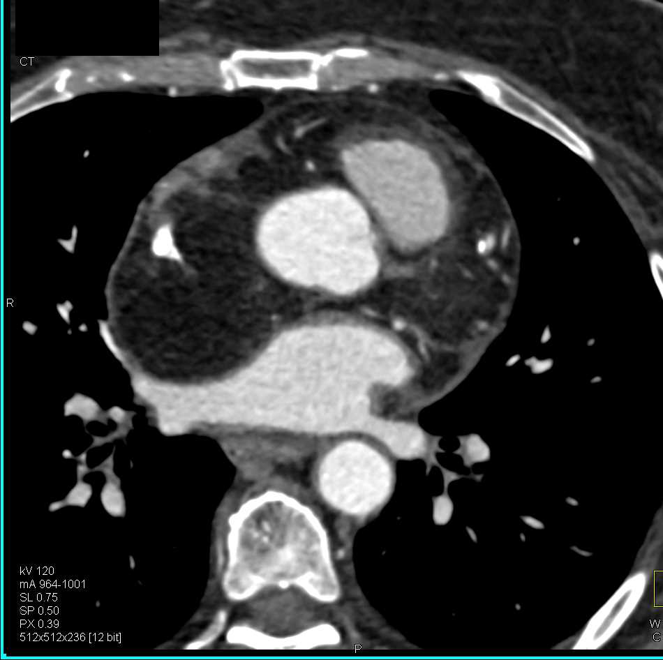 Intrapericardial Lipoma by Right Atrium - CTisus CT Scan