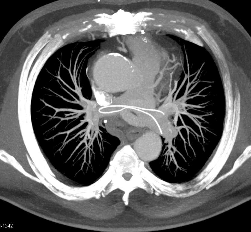 Broken Catheter Lodged in the Pulmonary Artery - CTisus CT Scan