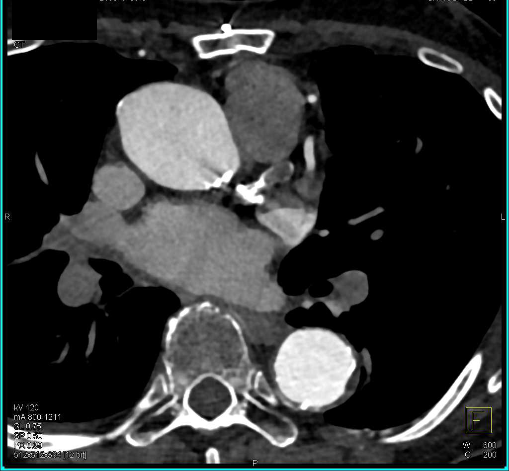 occluded Left Anterior Descending Coronary Artery (LAD) with Dilated LAD - CTisus CT Scan