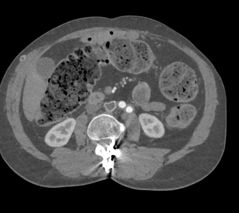Vasculitis with Aortic Repair - CTisus CT Scan