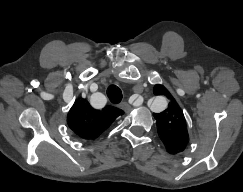Dissection Involves the Arch Vessels - CTisus CT Scan