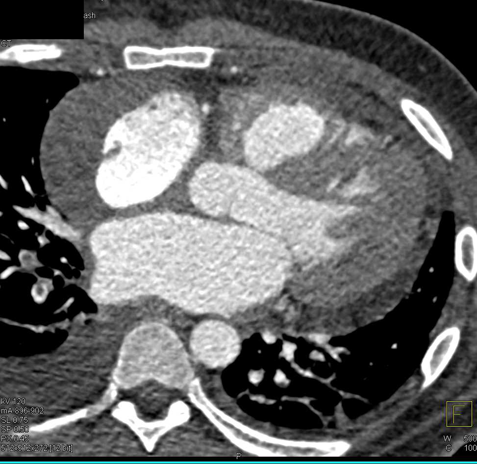 Multiple Right Pulmonary Artery Emboli - CTisus CT Scan