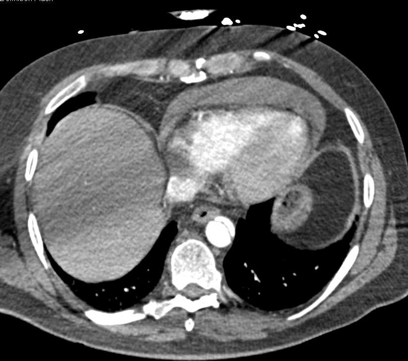 Type A Dissection with Hemopericardium - CTisus CT Scan