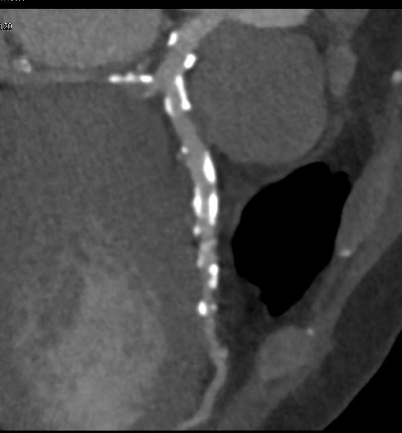 Coronary CTA with Agatston Score Well Above 1000 - CTisus CT Scan