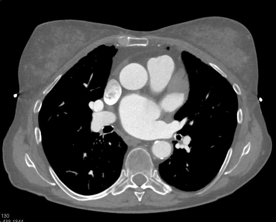 Pseudothrombus in Left Atrial Appendage - CTisus CT Scan