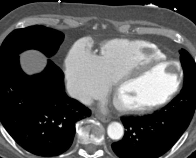 Left Ventricle Infarct - CTisus CT Scan