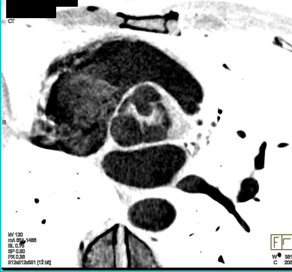 Dilated Ascending Aorta with Bicuspid Aortic Valve - CTisus CT Scan