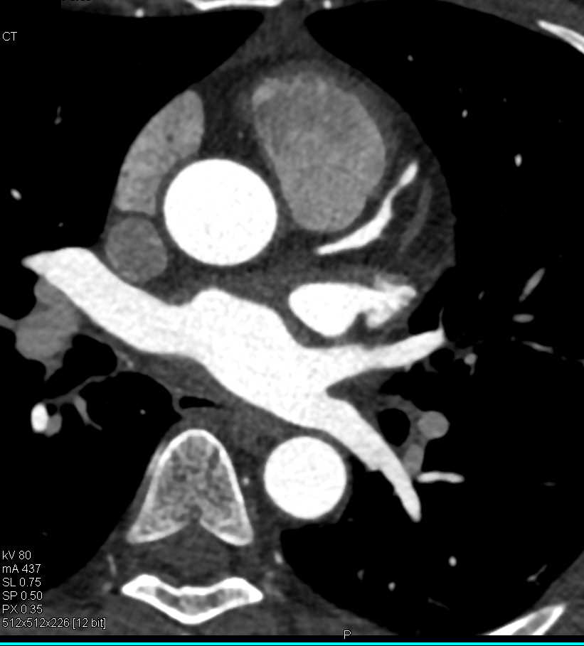 CCTA with Left Anterior Descending Coronary Artery (LAD) Stenosis - CTisus CT Scan