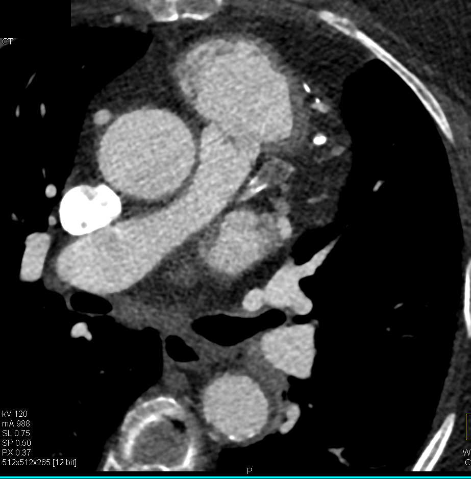 Aneurysm of Left Anterior Descending Artery (LAD) with Occlusion - CTisus CT Scan