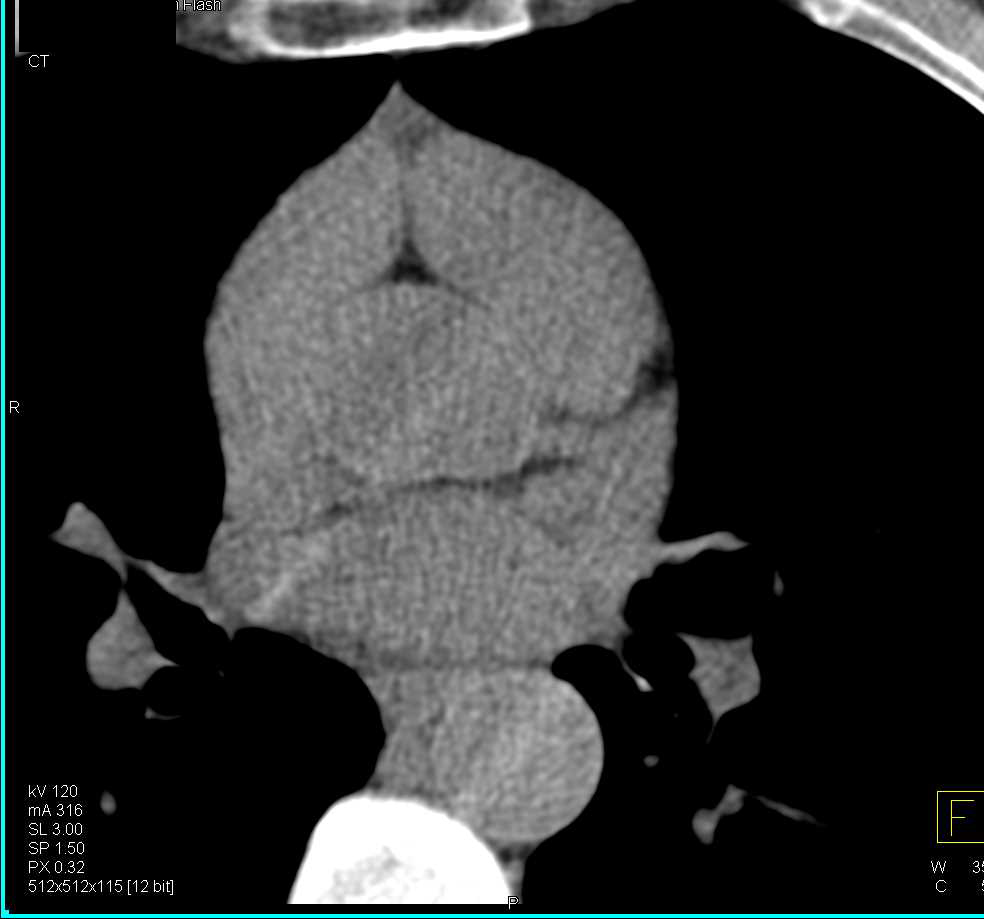 Papillary Fibroelastoma of the Aortic Valve - CTisus CT Scan