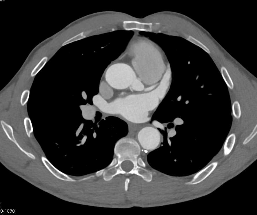 Dilated Coronary Artery Buttons in Patient s/p Reimplatation Following Root Repair - CTisus CT Scan
