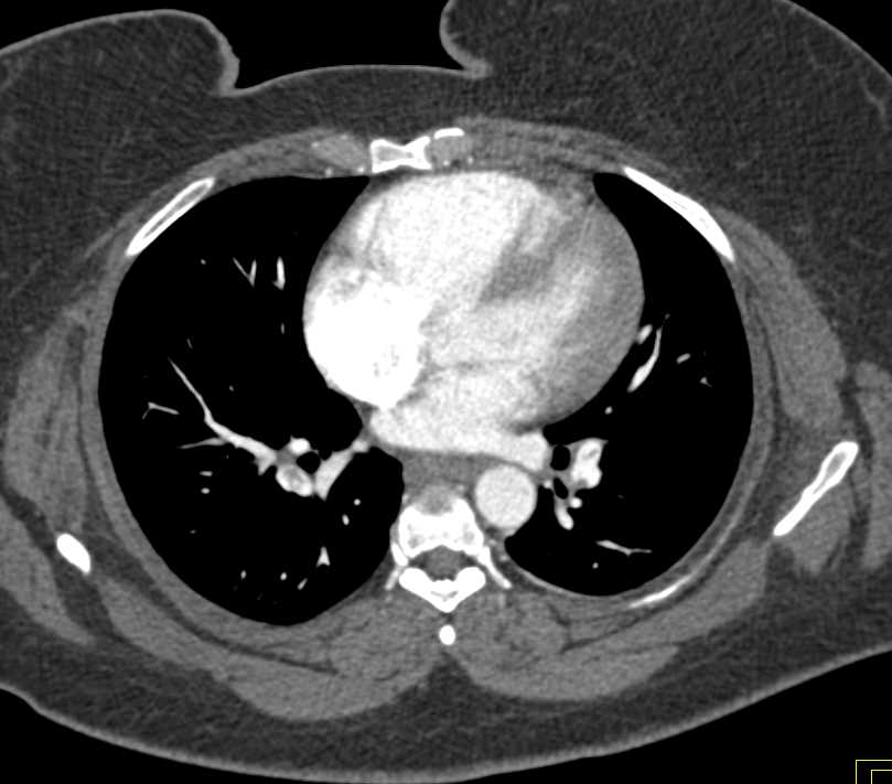 Multiple Bilateral Pulmonary Emboli - CTisus CT Scan