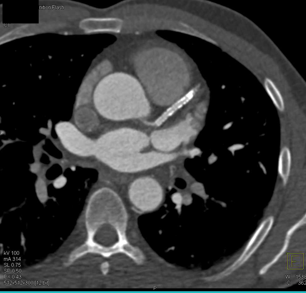 CCTA: Patent Coronary Artery Stent - CTisus CT Scan