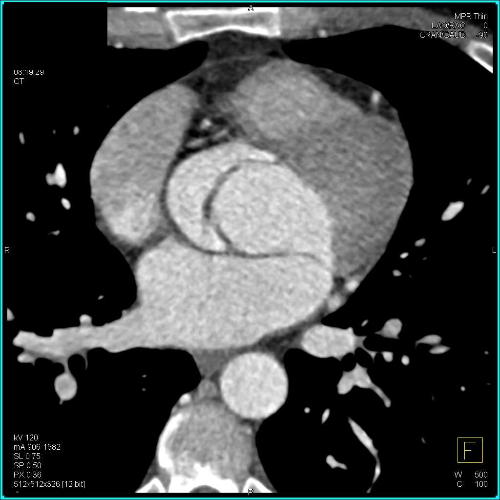 Bicuspid Aortic Valve - CTisus CT Scan