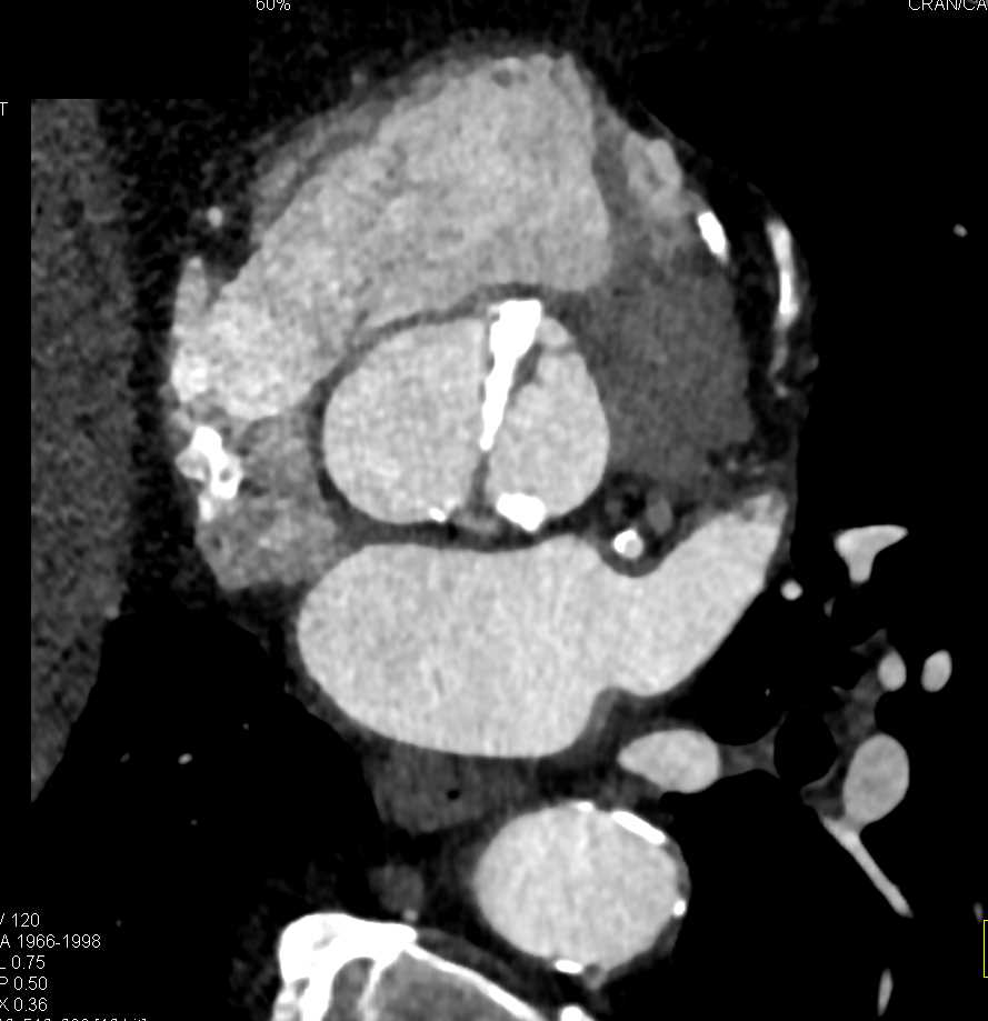 Calcified Bicuspid Aortic Valve - CTisus CT Scan