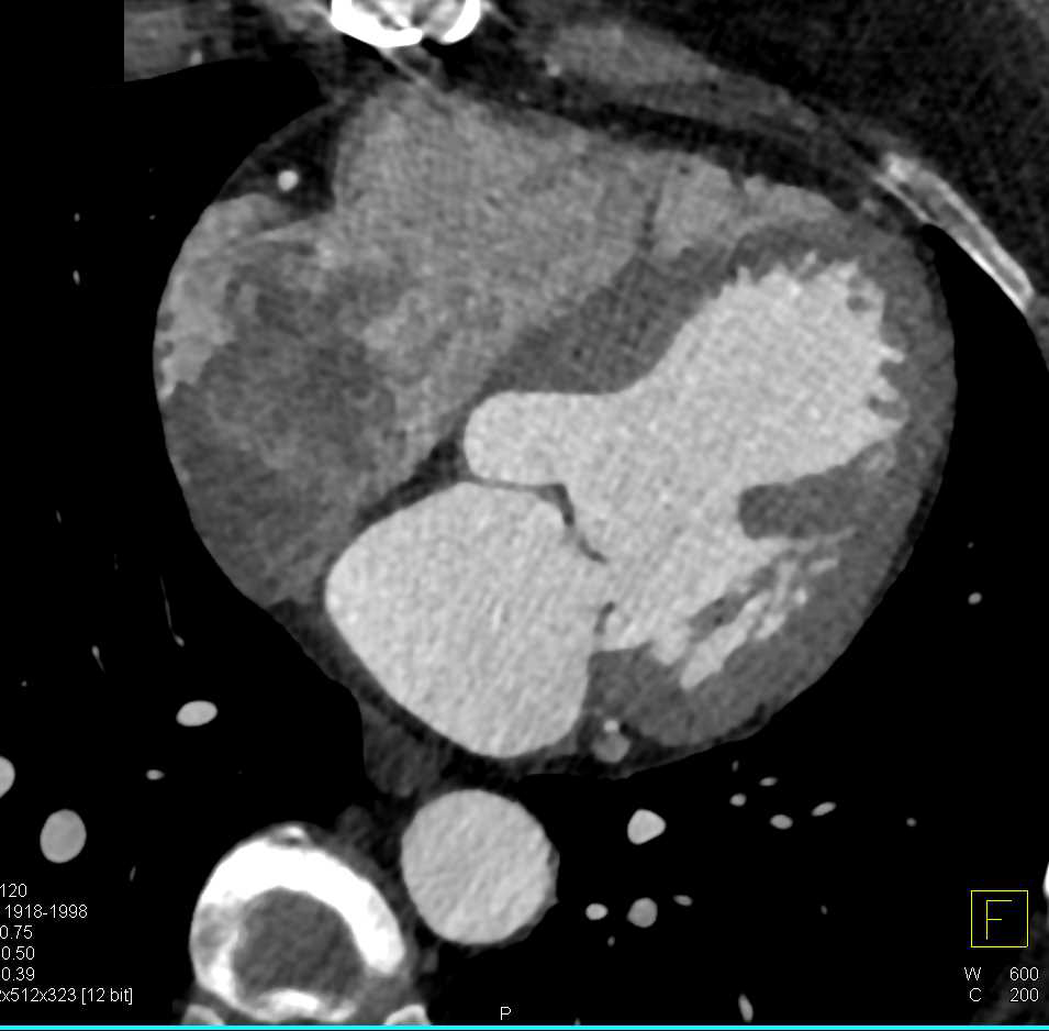 Pseudoclot in the Right Atrium - CTisus CT Scan
