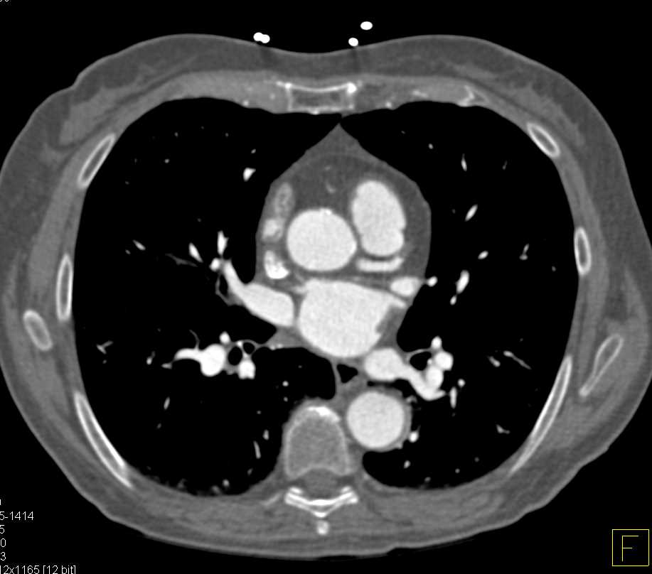 CCTA: Occlusion of the Left Anterior Descending Artery (LAD) - CTisus CT Scan