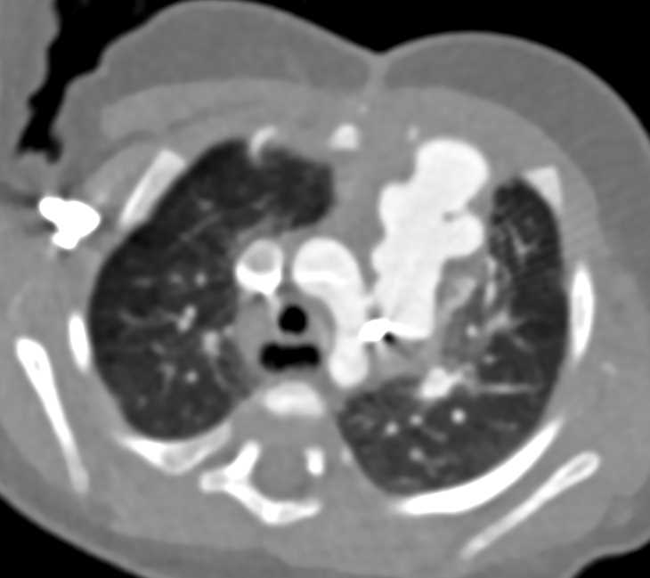 Post repair of Main Pulmonary Artery - CTisus CT Scan