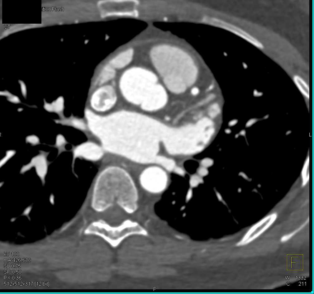 Mild Coronary Artery Disease Especially in the Left Anterior Descending Artery (LAD) - CTisus CT Scan