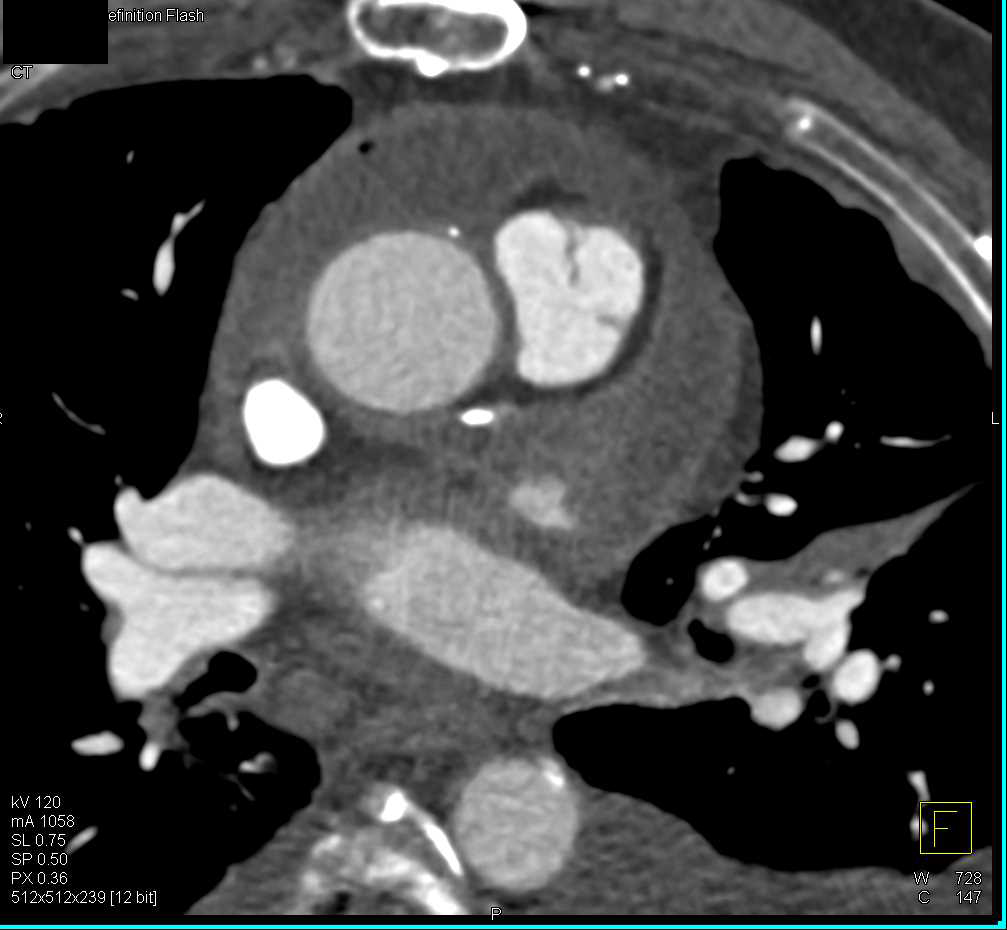 Pericardial Effusion - CTisus CT Scan