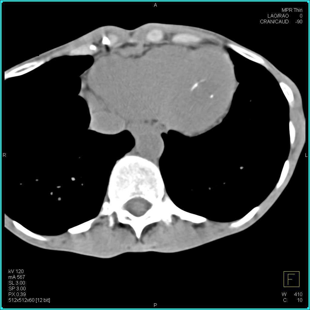 Thrombus Left Ventricle - CTisus CT Scan