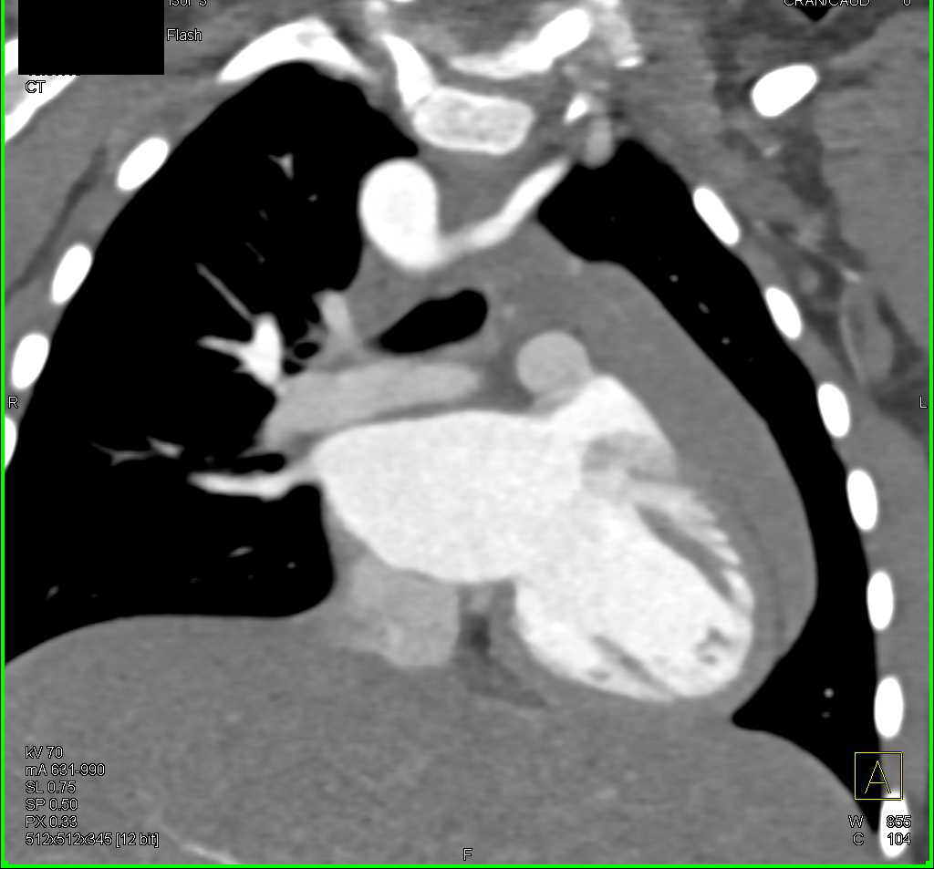 Pericardial Effusion - CTisus CT Scan