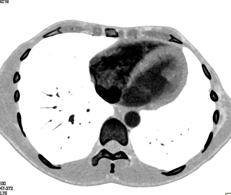 Clot in the Left Ventricle - CTisus CT Scan