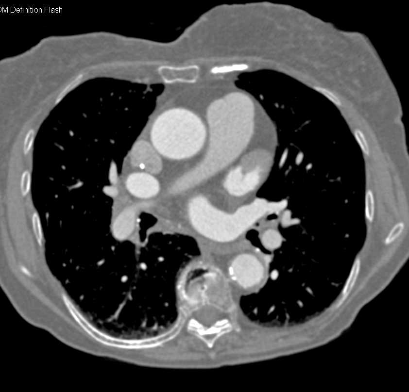 Thrombus in the Left Atrial Appendage - CTisus CT Scan