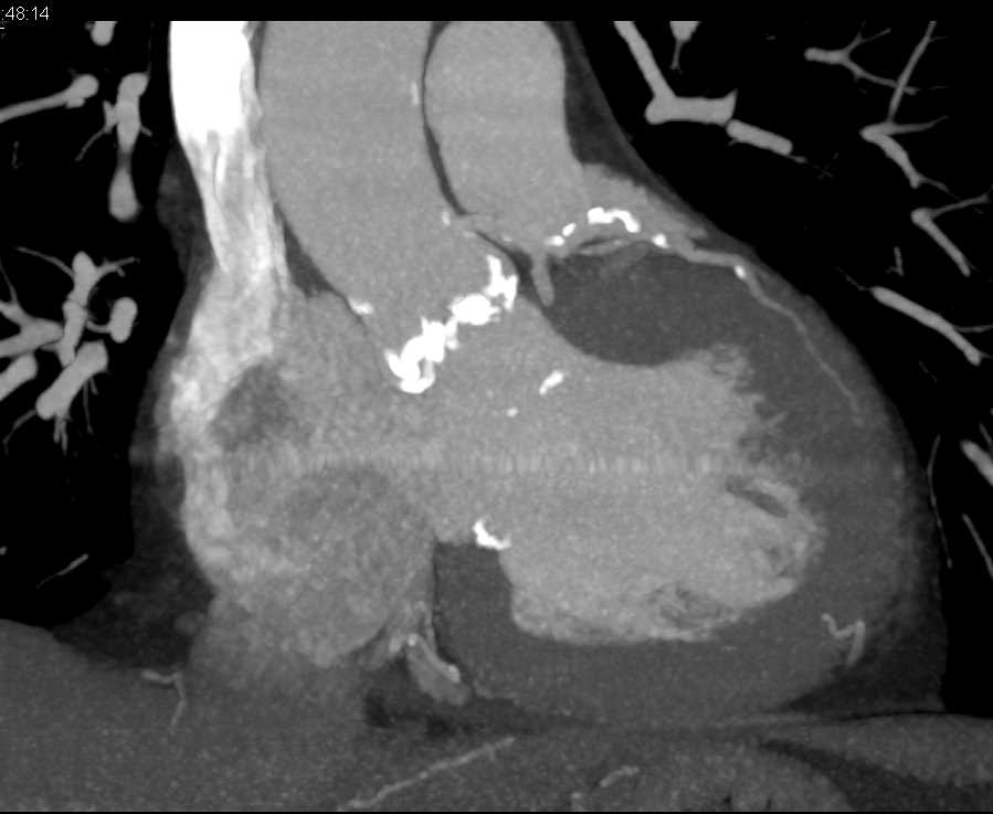 Aortic and Mitral Valve Calcifications - CTisus CT Scan
