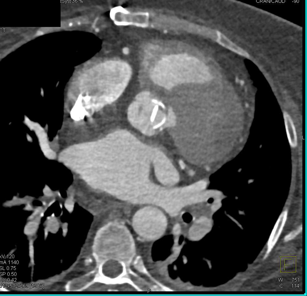 Aortic Valve Replacement (AVR) with No Evidence of Aneurysm - CTisus CT Scan