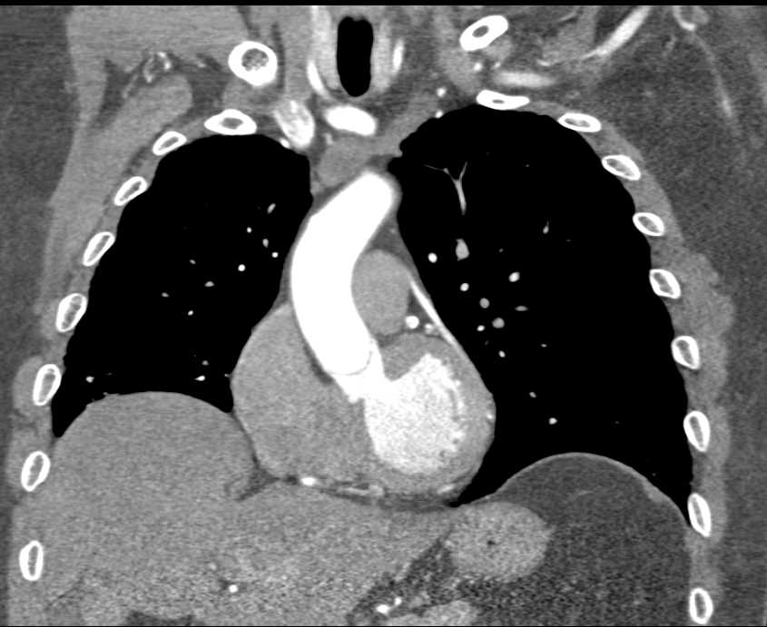 Coronary Artery Bypass Graft (CABG) with 3D VRT of the Bypass Grafts - CTisus CT Scan