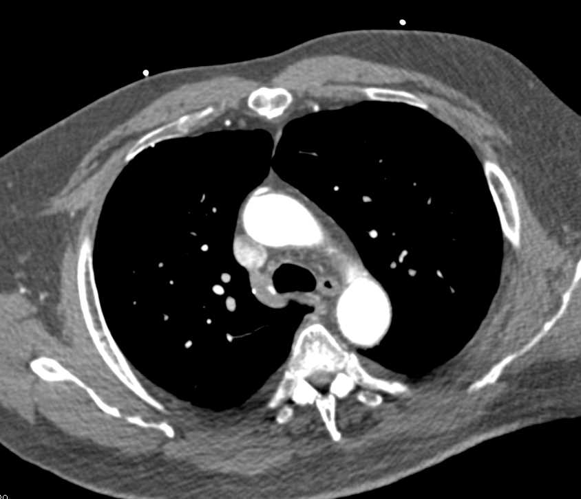 Coronary Artery Bypass Graft (CABG) with 3D VRT of the Bypass Grafts - CTisus CT Scan