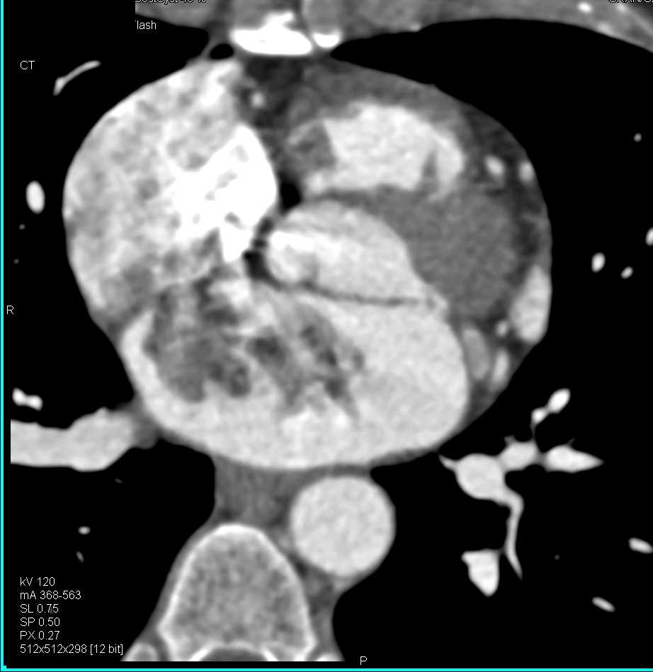 Left Atrial Myxoma - CTisus CT Scan