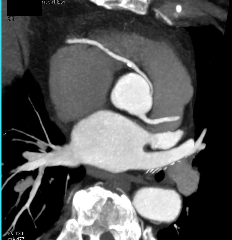 CCTA: Right Coronary Artery (RCA) Arises of the Left Cusp - CTisus CT Scan