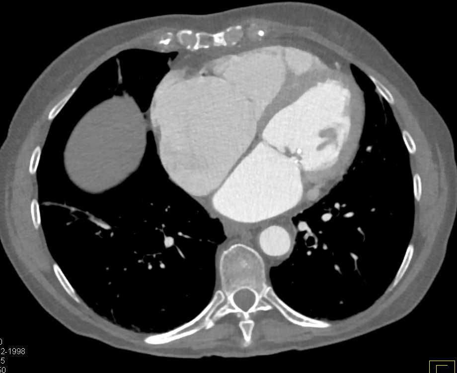 Mitral Valve Calcifications in Annulus - CTisus CT Scan