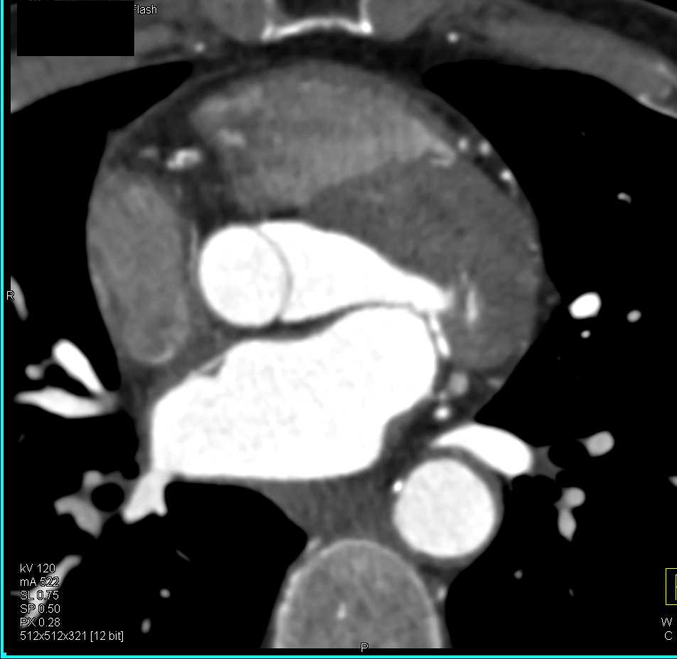 CCTA: Plaque in the Right Coronary Artery (RCA) - CTisus CT Scan