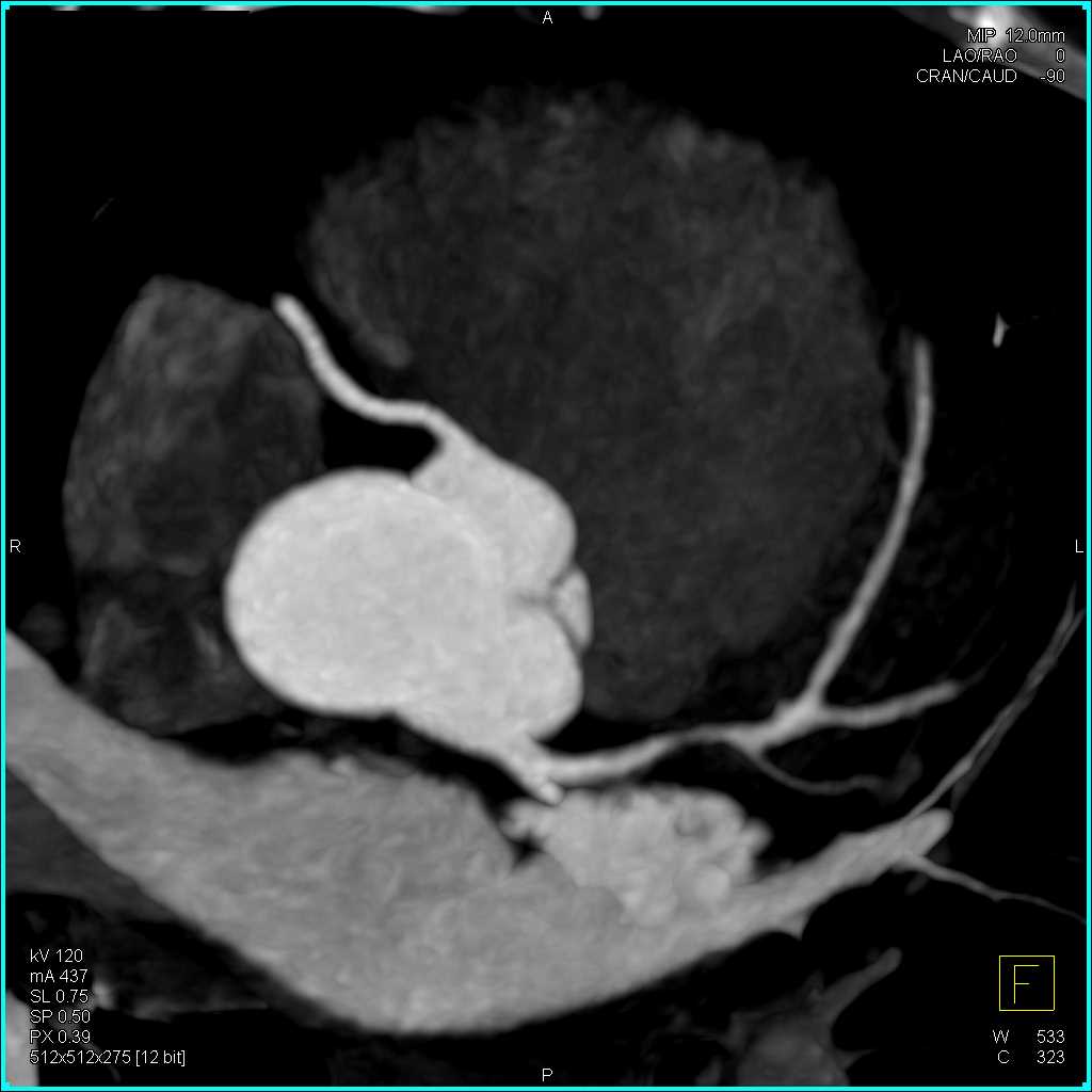 CCTA: Left Anterior Descending Artery (LAD) Stenosis with Non-calcified Plaque - CTisus CT Scan